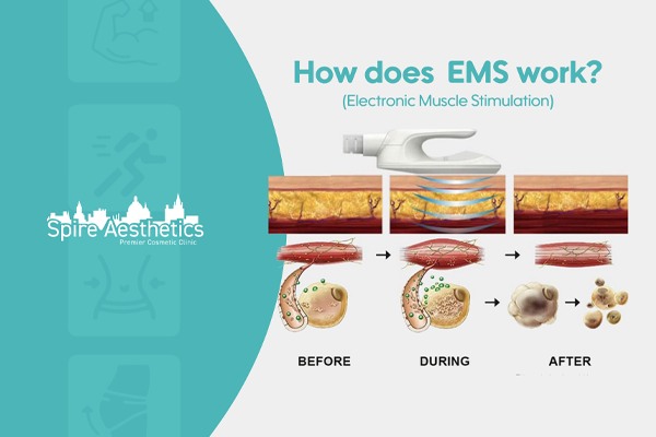 EMS treatment for post pregnancy weight loss treatment Wooburn Green