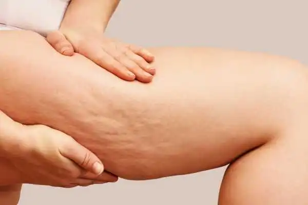 Image of woman showing leg with cellulite Wooburn Green