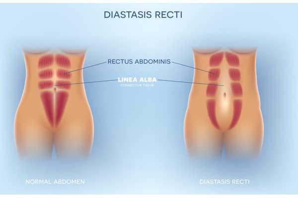 What Non-Surgical Options Are Available for Diastasis Recti Wooburn Green?