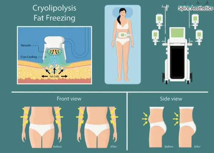 Fat freezing treatment Wooburn Green benefits for competitions to remove stubborn fat deposits.