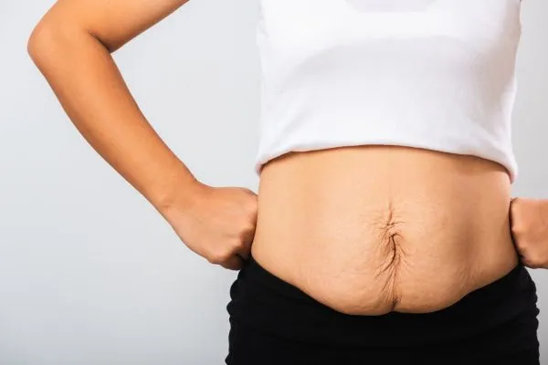 Image of a woman's stomach after weight loss with sagging skin following a gastric band Wooburn Green