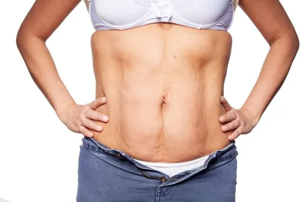 sagging skin on woman's stomach after weight loss injections Wooburn Green