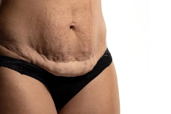 Image of womans stomach after weight loss injections Wooburn Green showing saggy skin