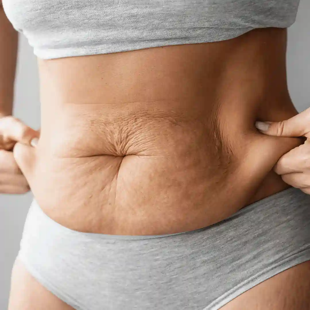 Is It Normal to Have Loose Skin After Pregnancy Wooburn Green?