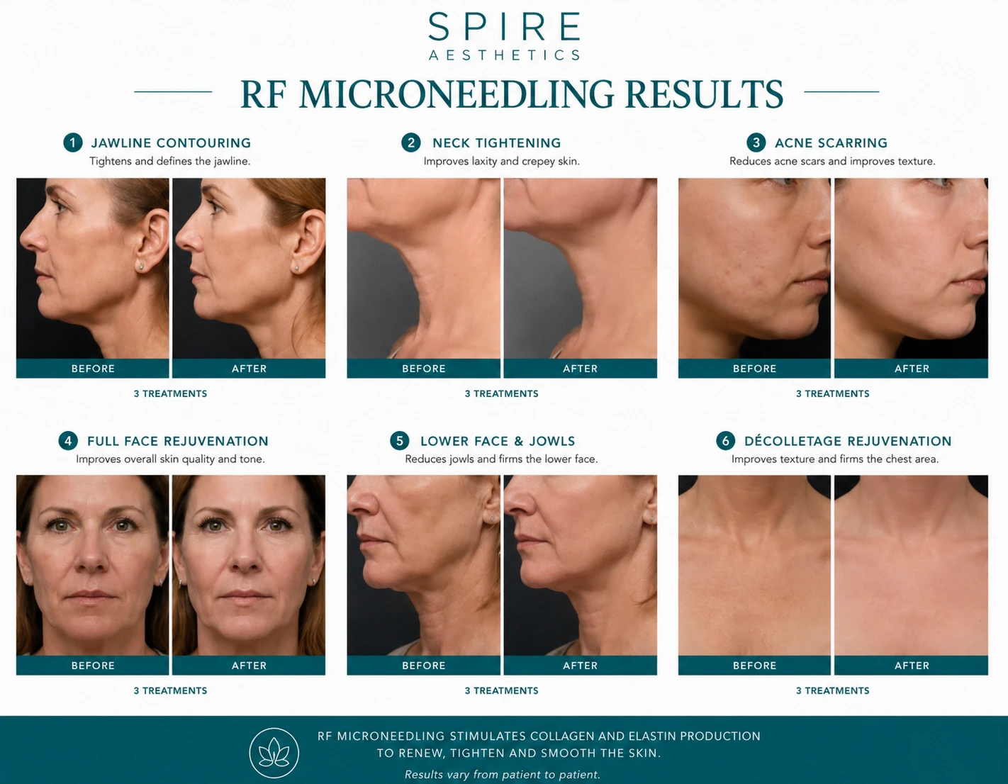 RF Microneedling Skin tightening Wooburn Green results