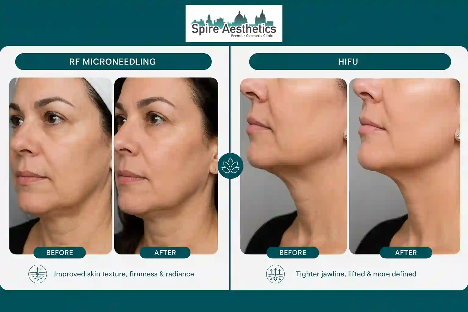 Can RF Microneedling and HIFU Be Combined Wooburn Green?