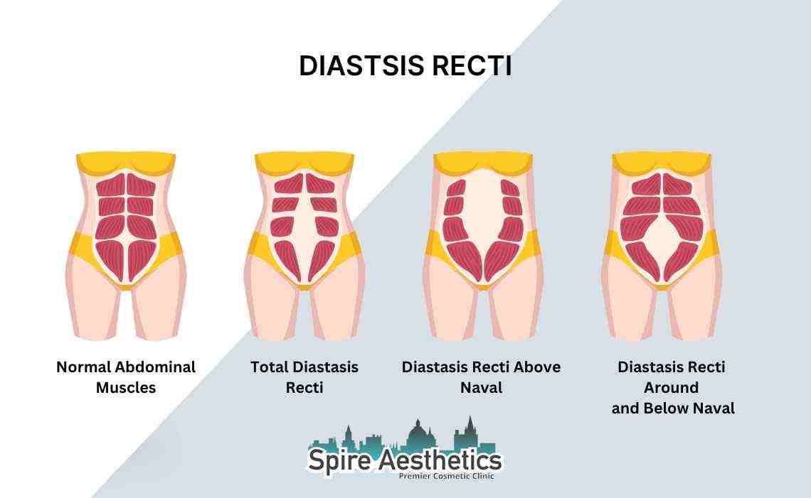 Is Non-Surgical Diastasis Recti Treatment Right for You? Common Concerns Answered Wooburn Green